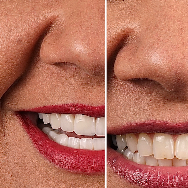 Crowns in Houston, TX