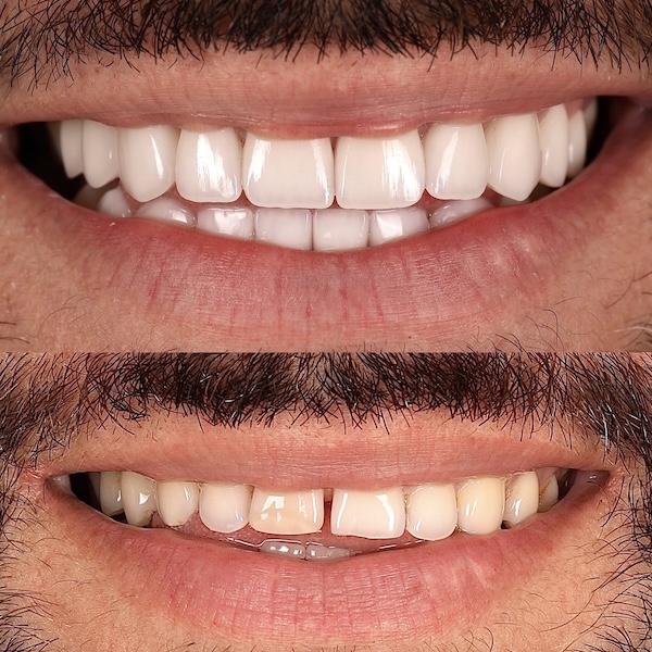 Veneers in Houston, TX